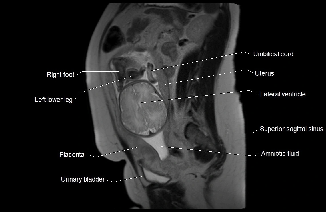 MRI fetal anatomy sagittal image 23.webp